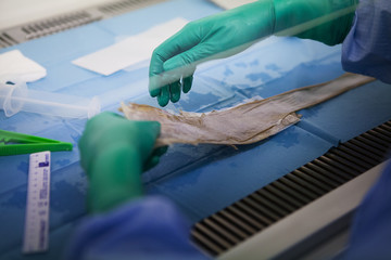 przeszczep - Fotolia