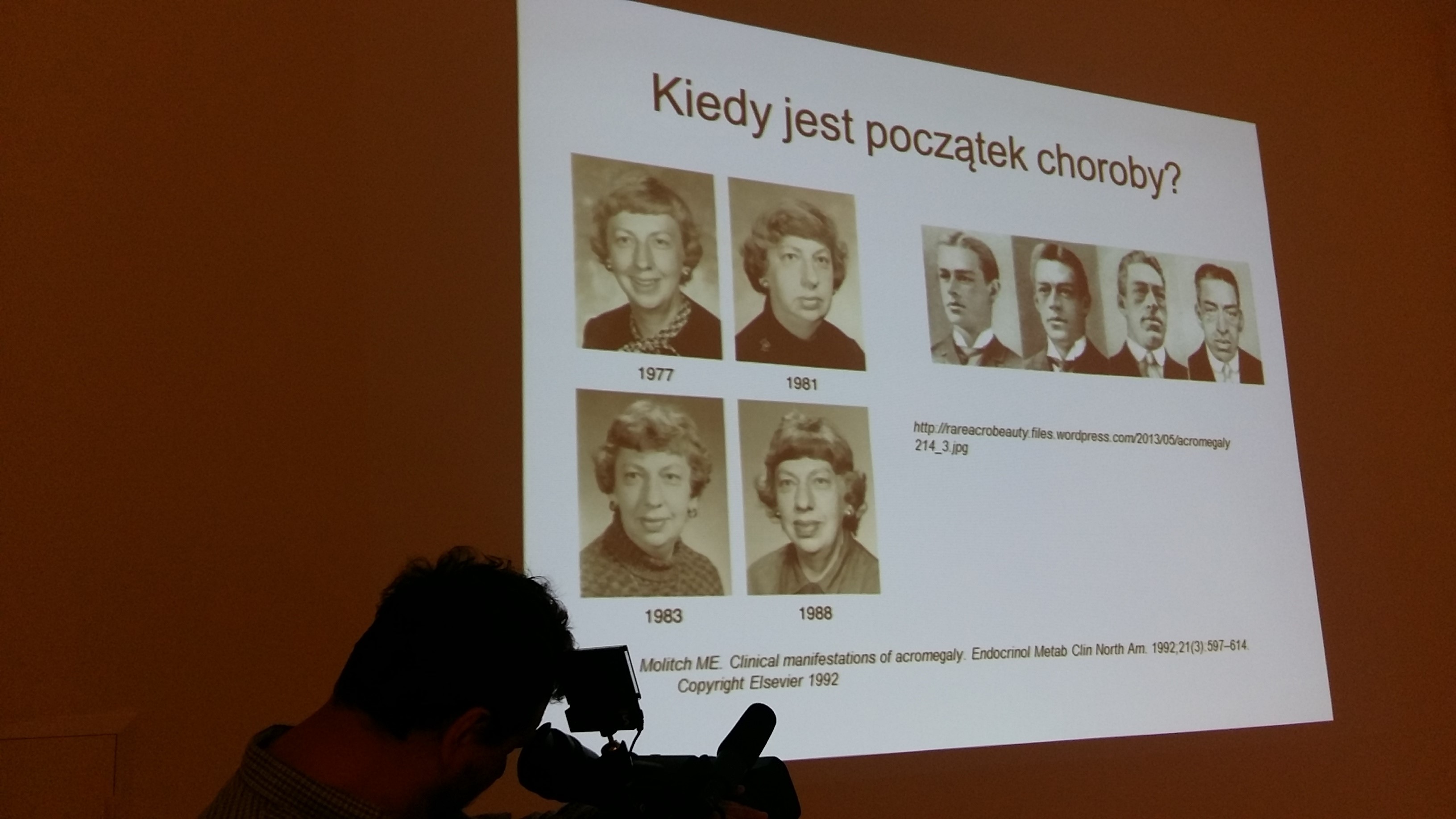 akromegalia - Magdalena Konieczna