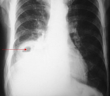 zapalenie płuc - mp.pl