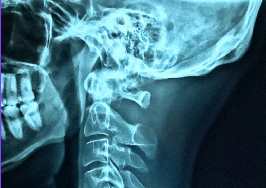 Prześwietlenie czaszki - Getty images