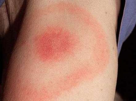 Rumień, borelioza - Sanepid